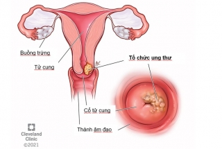 UNG THƯ CỔ TỬ CUNG CÓ THỂ PHÒNG NGỪA ĐƯỢC KHÔNG?